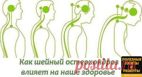 БОЛИТ ШЕЯ? КАК ШЕЙНЫЙ ОСТЕОХОНДРОЗ ВЛИЯЕТ НА НАШЕ СОСТОЯНИЕ. 
На начальном этапе изменения претерпевают кости и связки. И о том наш организм сигнализирует периодической болью или нарушением чувствительности отдела, пораженного остеохондрозом. Затем появляются трещины и меняется высота стояния диска, а точки прикрепления мышц и связок, принадлежащие двум соседним позвонкам, сближаются. 
Поэтому мышцы и связки провисают и позвонки начинают легко соскальзывать или смещаться относительно друг друг