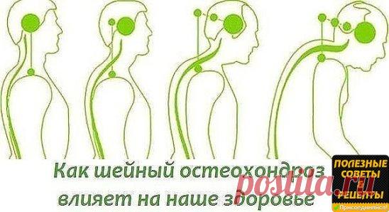 БОЛИТ ШЕЯ? КАК ШЕЙНЫЙ ОСТЕОХОНДРОЗ ВЛИЯЕТ НА НАШЕ СОСТОЯНИЕ. 
На начальном этапе изменения претерпевают кости и связки. И о том наш организм сигнализирует периодической болью или нарушением чувствительности отдела, пораженного остеохондрозом. Затем появляются трещины и меняется высота стояния диска, а точки прикрепления мышц и связок, принадлежащие двум соседним позвонкам, сближаются. 
Поэтому мышцы и связки провисают и позвонки начинают легко соскальзывать или смещаться относительно друг друг
