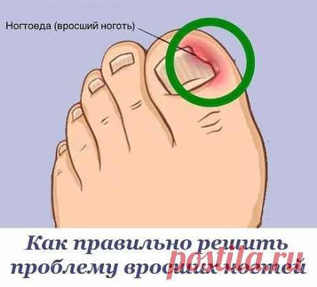 Вросший ноготь
