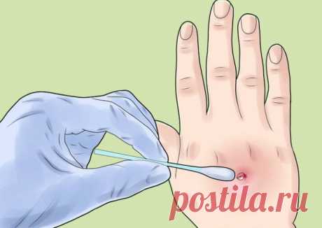 Что нужно знать о золотистом стафилококке? / Будьте здоровы