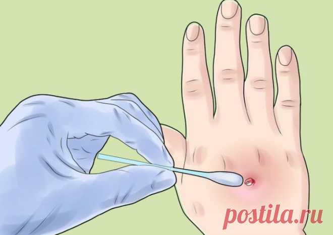 Что нужно знать о золотистом стафилококке? / Будьте здоровы