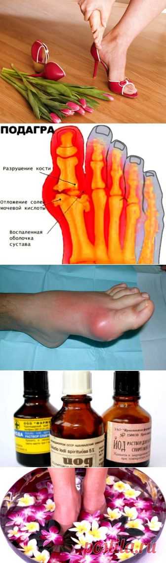 Домашнее лечение подагры