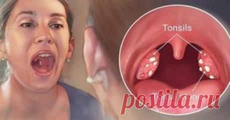 Как избавиться от воспаления миндалин быстро в течение 24 часов Здесь мы узнаем о том, как быстро избавиться от воспаления миндалин в …