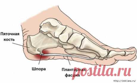 Как вылечить пяточную шпору: 8 народных рецептов