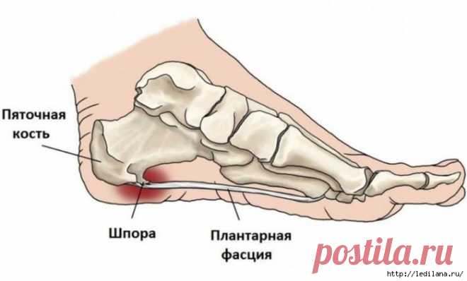 Как вылечить пяточную шпору: 8 народных рецептов