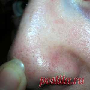 Единственное средство которое действительно помогло убрать черные точки - МирТесен