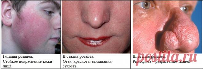 Лечи покраснение, лопнувшие сосуды немедленно, это может привести к развитию розацеа, 4 натуральных рецепта Покраснение является не только эстетической проблемой, потому что в дальнейшем развитие  розацеа может привести к разрастанию тканей. Смотрите!
Каждая женщина мечтает о здоровой и гладкой коже. К сожа…