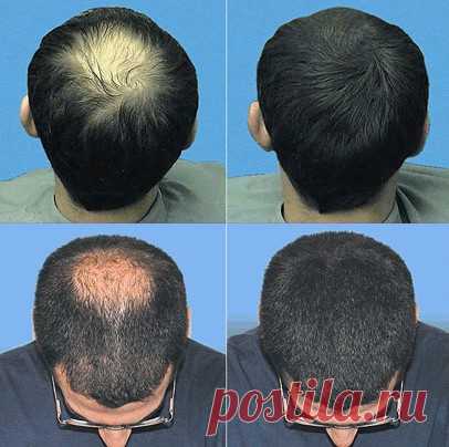 Лазер для волос: видео-инструкция по лечению своими руками, лазерные расчески, щетки, терапия, фото и цена