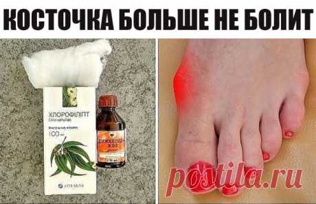 Косточка больше не болит! Потратила мелкие деньги на 2 средства, эффект невероятен!

Делюсь рецептом от операционной медсестры!

Помню, как однажды на уроке биологии почувствовала себя по-настоящему ужасно. Мы изучали что-то связанное с генетикой, и учительница рассказывала нам о том, какие генетические заболевания передаются по наследству.

В качестве яркого примера она привела косточку на ноге. Увеличенная косточка, некрасивая и болезненная, как подробно расписывала преп...