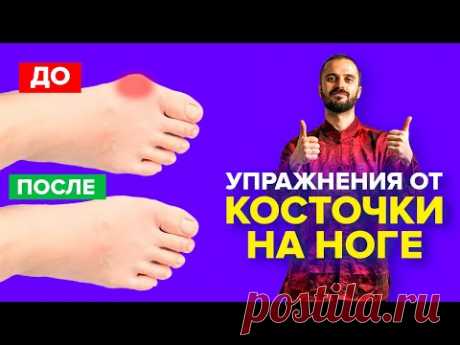 Упражнения от косточки на ноге, гимнастика для большого пальца ноги / Вальгусная деформация.