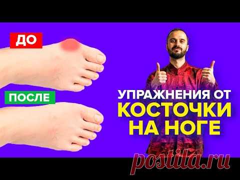 Упражнения от косточки на ноге, гимнастика для большого пальца ноги / Вальгусная деформация.