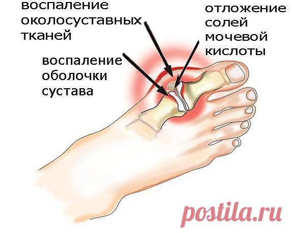 Подагра на ногах