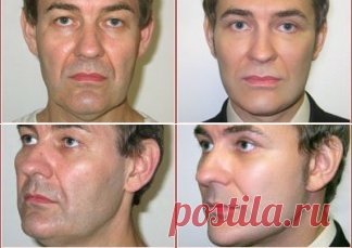 Восстановление овала лица в Москве. Цены и фото после процедуры.