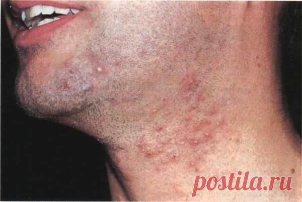 Воспаление волосяного фолликула: видео-инструкция как лечить своими руками, особенности лечения под мышкой, на лобковой части, в паху, цена, фото