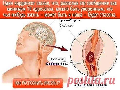 РАСПОЗНАВАНИЕ СИМПТОМОВ ИНСУЛЬТА