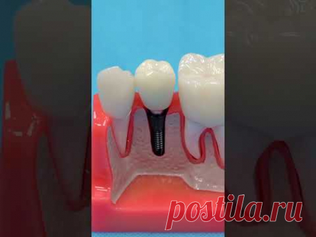 Импланты, коронки, исправление прикуса — ZemsClinic.ru #shorts #стоматологиямосква #лечениезубов