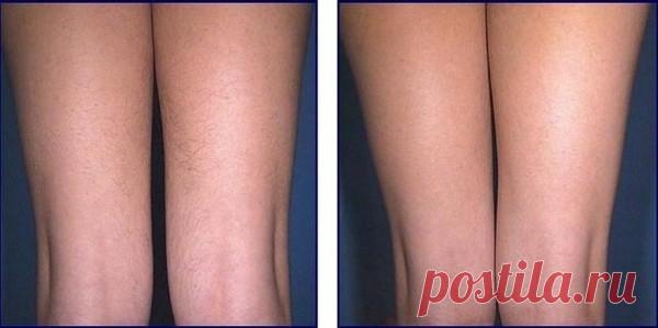 Эпиляция ног: видео-инструкция как сделать своими руками, особенности фотоэпиляции, электроэпиляции, удаления волос воском, рецепты для проведения в домашних условиях, как избавиться от черных точек после процедуры, цена, фото