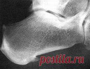 Как лечить шпоры на пятках в домашних условиях | Азбука здоровья