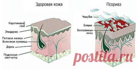Псориаздың жіктелуі Псориаз түріне байланысты бірнеше топтарды біріктіретін екі ірі топ бар: Pustular түрі, соның ішінде: жалпыланған нысаны (Цумбюс ауру, акродермитит Allopo, herpetiform empedigo); пальма-планталь (пальма-планталь) нысаны; циркуляциялық центрифугалық эритема ретінде ағып кетеді. Бос емес типті жабын: ерте немесе ерте басталатын дәстүрлі қарапайым нысаны; псориаз эритродерма. Негізгі классификацияға кірмейтін аурулардың түрлері: географиялық жағдайы; экссу...