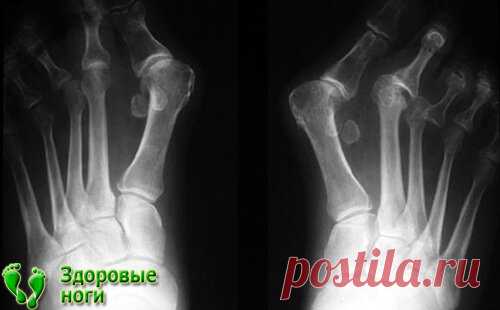 «Вальгусная деформация стопы: причины, лечение, операция  В статье рассматривается вальгусная деформация стопы, ее причины, симптоматика и процесс лечения. На первой (начальной) стадии болезни можно выделить такие проявления: Самый первый и главный симптом болезни – это дискомфортные, а также болезненные ощущения во время ходьбы, наличие быстрой утомляемости, трудности с ношением обуви, после чего начинают появляться болезненные натоптыши и мозоли. ...