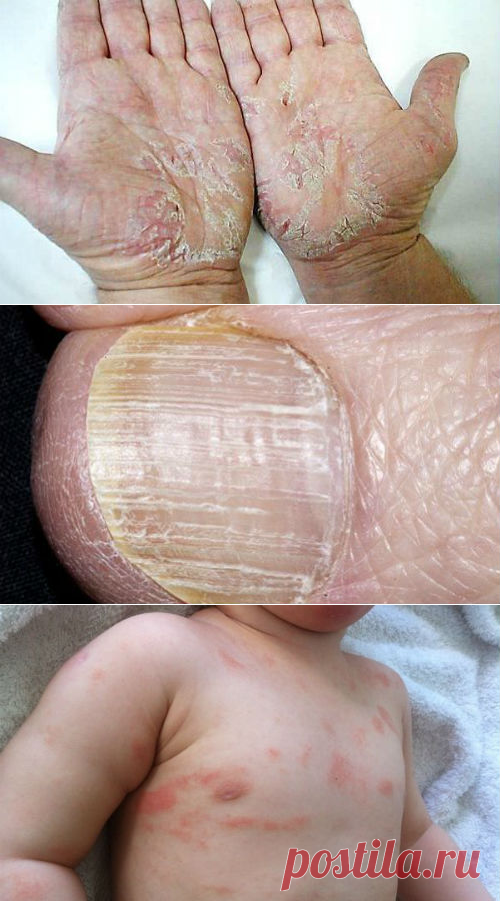Как начинается псориаз, признаки, симптомы, причины появления