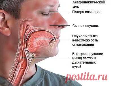 Первая помощь при анафилактическом шоке | Первая помощь
