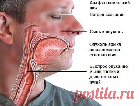 Первая помощь при анафилактическом шоке | Первая помощь