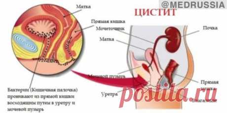 Цистит 
Цистит – воспаление слизистой оболочки мочевого пузыря. В большинстве случаев цистит имеет инфекционную природу. Заболевание широко распространено, поражает представителей слабого и сильного пола, но чаще встречается у женщин в силу некоторых анатомических особенностей строения женского организма. 
Женская уретра (мочеиспускательный канал) шире и короче мужской, поэтому возбудителям инфекции проще проникнуть в мочевой пузырь. Это обуславливает более частую встречаемость цистита у женщи