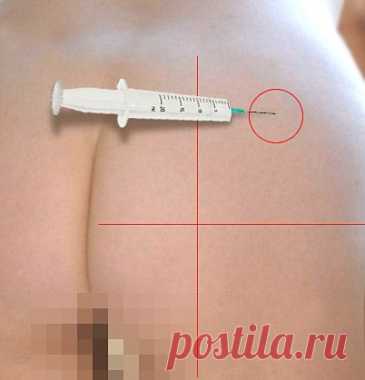 Как правильно сделать укол внутримышечно в ягодицу?