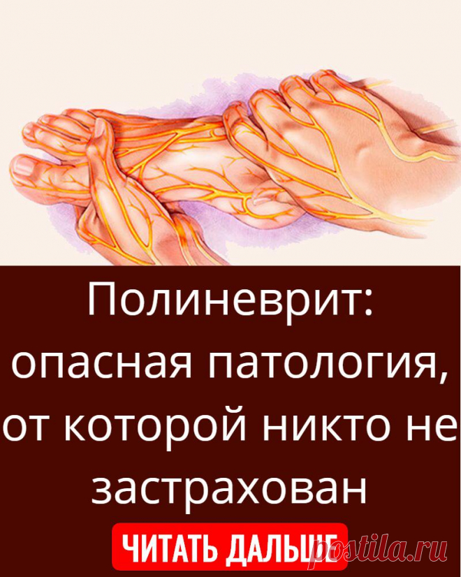 Полиневрит: опасная патология, от которой никто не застрахован