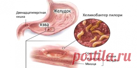 Схема лечения хеликобактера пилори. Нужно ли лечить?