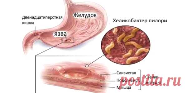 Схема лечения хеликобактера пилори. Нужно ли лечить?