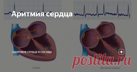 Аритмия сердца  "У меня аритмия сердца. Это опасно или нет?" -  Это самый частый вопрос к кардиологу, особенно в соцсетях.  Давайте разбираться, вопрос непростой и сразу требует уточнения, что диагноза «аритмия сердца» нет.  Дословно аритмия означает, что есть нарушения частоты, ритмичности и последовательности возбуждения в сердце. Существует огромное количество аритмий, у каждой аритмии есть своё название( диагноз), причина и способ лечение. Подавляющее количество аритми...