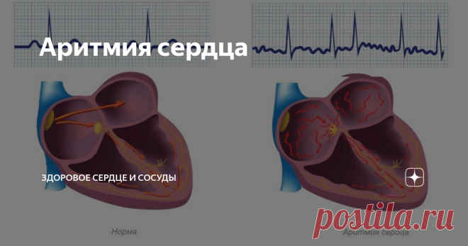 Аритмия сердца  