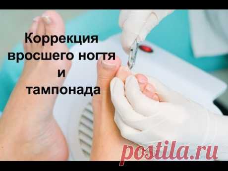 Коррекция вросшего ногтя и тампонада / Correction of ingrown nail and tamponada