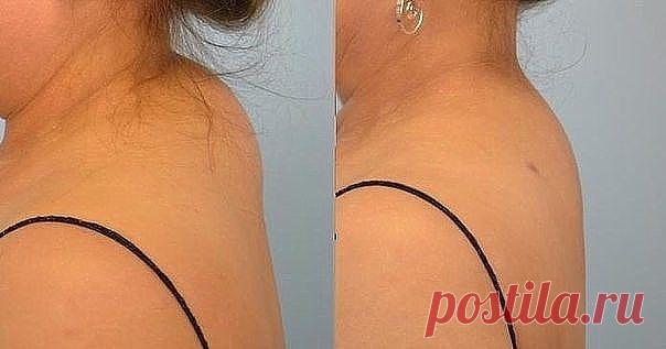 КАК ИЗБАВИТЬСЯ ОТ ХОЛКИ НА ШЕЕ

У многих женщин после 35-40 лет в области седьмого шейного позвонка часто появляется 