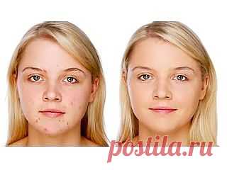 Проблемная кожа. Уход за проблемной кожей лица домашними средствами. Подростки и взрослые, мужчины и женщины — с проблемой угревой сыпи сталкиваются все.