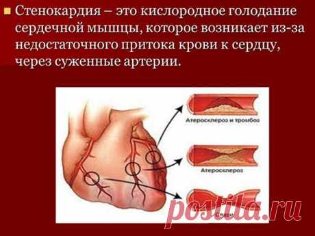 Приступ стенокардии: признаки, первая помощь и лечение