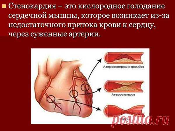 Приступ стенокардии: признаки, первая помощь и лечение