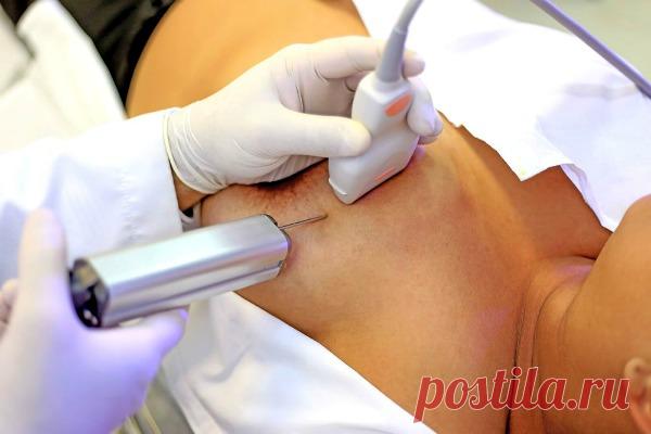 Пункция молочной железы под контролем УЗИ: больно или нет делать биопсию, методы проведения, показания, последствия, цена