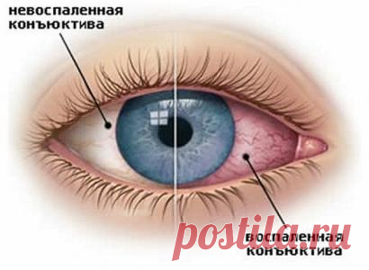 Воспаление глаз. Рецепты народной медицины