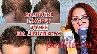 Трихологи советуют! Это очень сильное средство! Даже на лысинах начинают расти волосы! | С Лёгкой Руки | Дзен