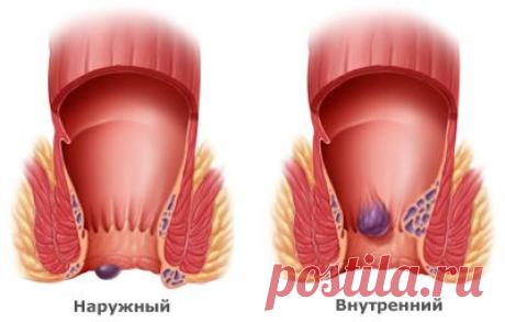 Лечение геморроя народными способами | Правила здоровья и долголетия