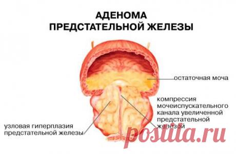 АДЕНОМА ПРОСТАТЫ - СИМПТОМЫ И ЛЕЧЕНИЕ