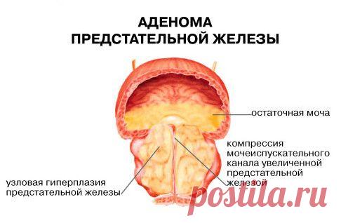 АДЕНОМА ПРОСТАТЫ - СИМПТОМЫ И ЛЕЧЕНИЕ