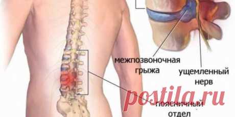 УПРАЖНЕНИЯ ПРИ МЕЖПОЗВОНКОВОЙ ГРЫЖЕ.
