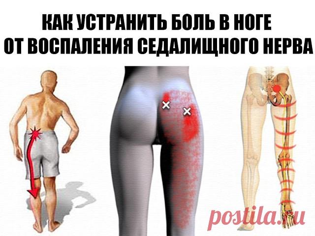 КАК УСТРАНИТЬ БОЛЬ В НОГЕ ОТ ВОСПАЛЕНИЯ СЕДАЛИЩНОГО НЕРВА?

Седалищный нерв – самый длинный и объемный нерв в теле человека. Самое распространенное заболевание – Ишиас, или воспаление седалищного нерва.Этот нерв начинается в поясничном отделе позвоночника, проходит через ягодицу, бедро, голень и заканчивается в стопе. Ишиас начинается остро, с сильной боли на каком-нибудь участке седалищного нерва.Я расскажу вам, как можно уменьшить боль и вылечить седалищный нерв народным...