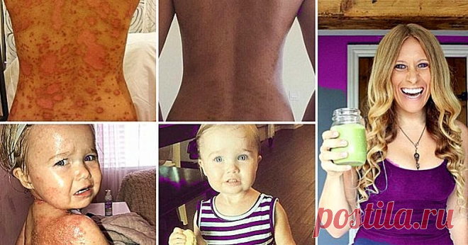 Псориаз и экзема: это средство помогло тысячам страдающих! - Интересный блог Реальная история! Существуют различные типы экземы кожи, но все они представляют собой симптомы, такие как зудящая, сухая и страшная кожа, которая обычно