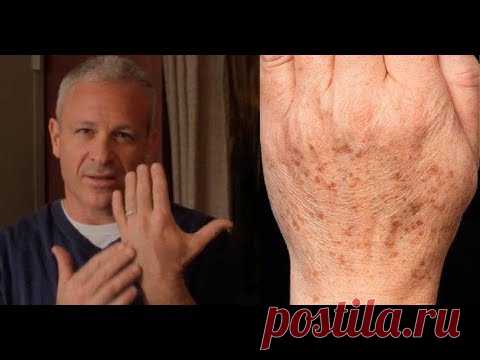 Что от нас скрывают/ Простой способ быстрого удаления пигментных пятен на коже