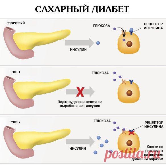 Сахарный диабет - какое эффективное лечение?